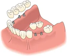 implant