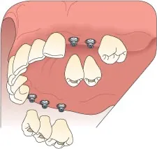 implant