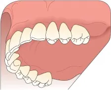 implant