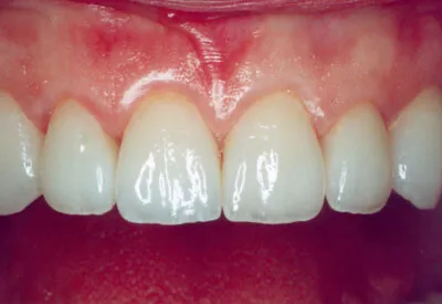 Porcelain Veneers Newtown PA