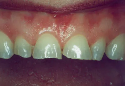 Porcelain Veneers Newtown PA