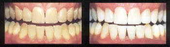 bleaching
