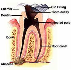 Root Canal
