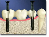 implant