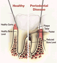 Gum Disease