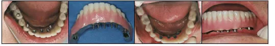 multiple implants