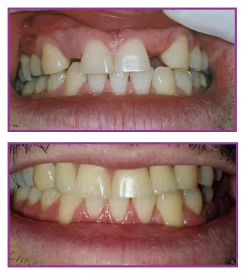 implant