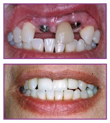  implant