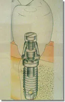 implant diagram