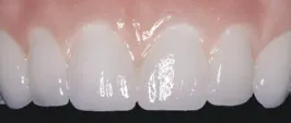 pretreatment wax-up