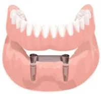 conventional denture