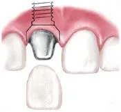implant