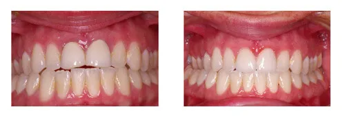 Before and after porcelain crowns matching front teeth