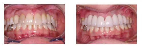 Before and after implant and crown treatment
