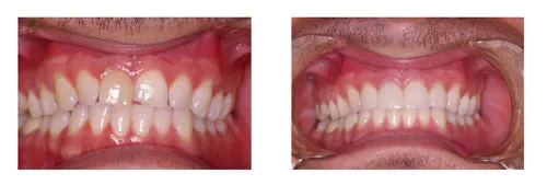 Before and after wedding smile treatment