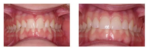 Before and after porcelain veneers closing spaces