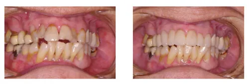 Before and after improved front teeth