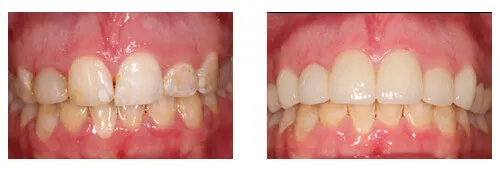 Before and after porcelain crown smile transformation