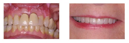Before and after replacement porcelain crowns
