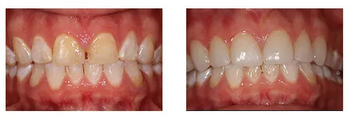Before and after porcelain crown treatment closing front-tooth gap