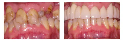 Before and after full smile restoration